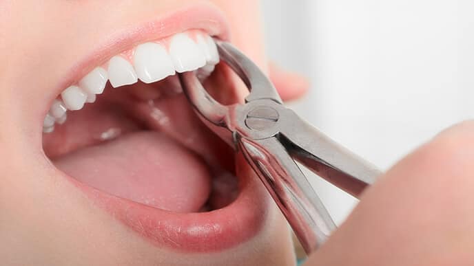 Альвеолит зуба: проблема, причины, решения