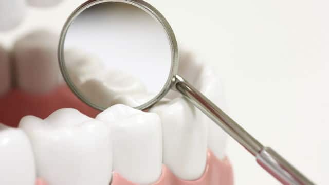 Зубной герметик: эффективное средство профилактики кариеса