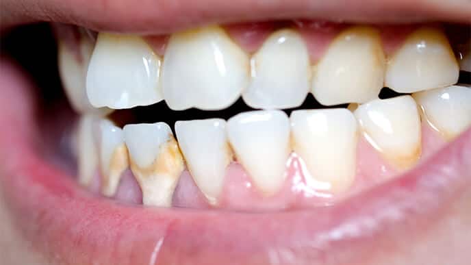Почему появляется зубной камень и как это предотвратить