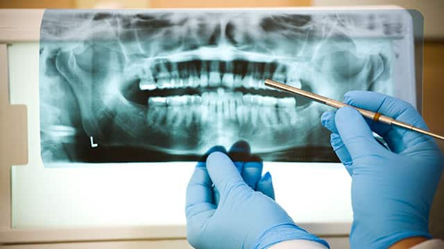 Причины гранулёмы зуба и её лечение