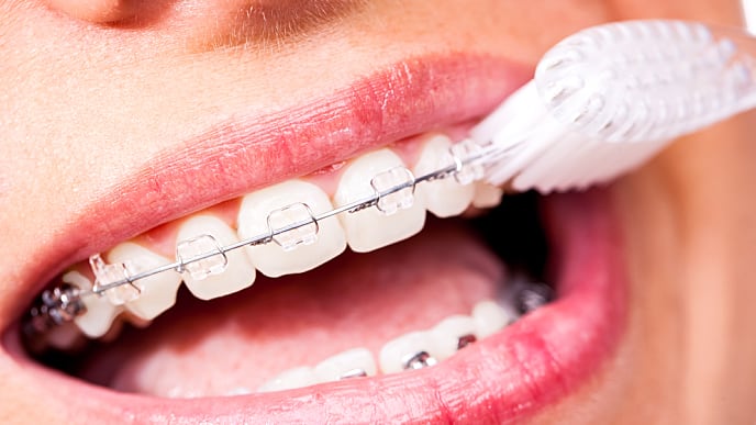 как правильно чистить зубы с брекетами